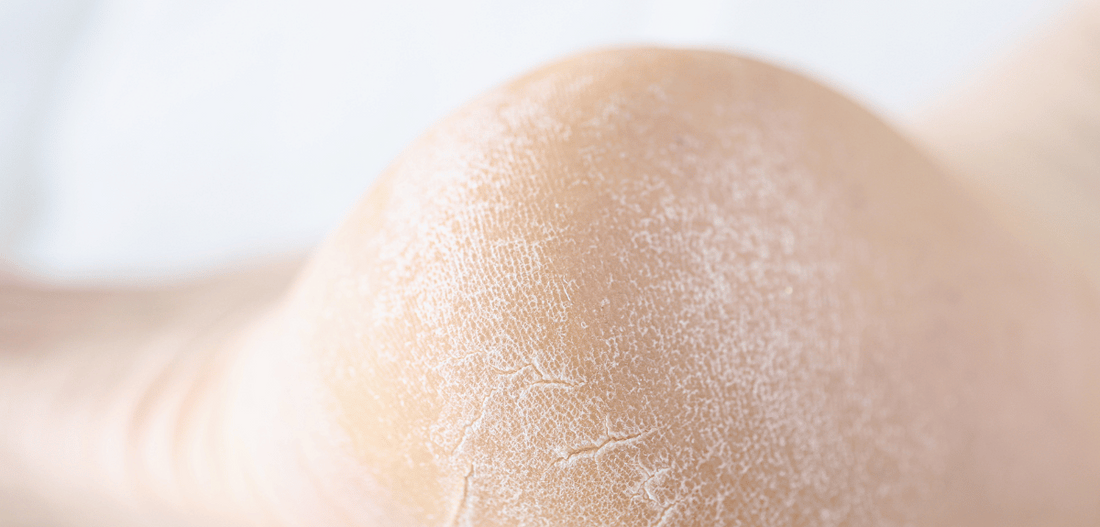 Kiss Dry, Cracked Heels Goodbye: Discover the Magic of NuSkin Sole Solution