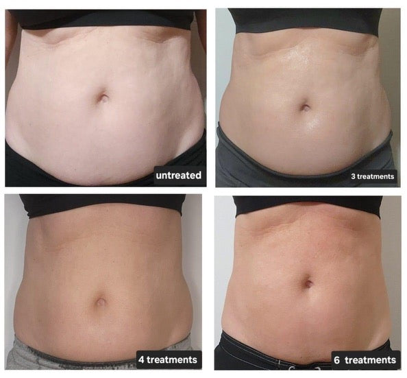 Nu Skin RenuSpa Result comparison pics