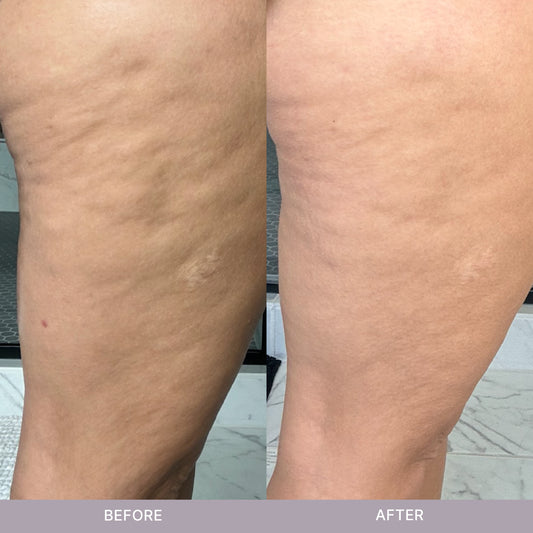 NuSkinRenuSpa iO Results side by side of female legs