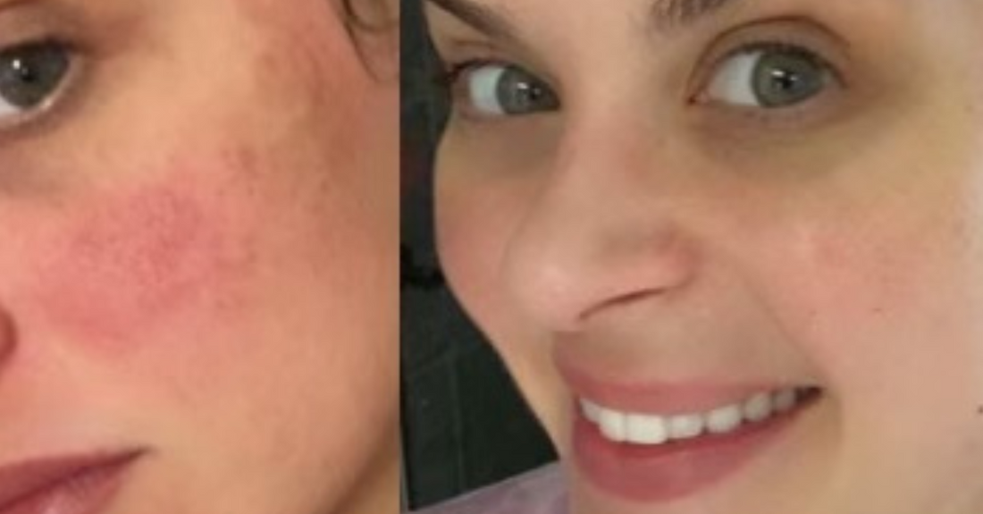 ageLOC LumiSpa iO rosacea results
