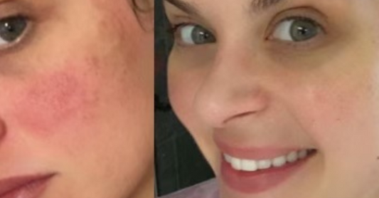 ageLOC LumiSpa iO rosacea results