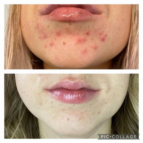 Gentle Exfoliation, KP relief - Epoch Polishing Bar