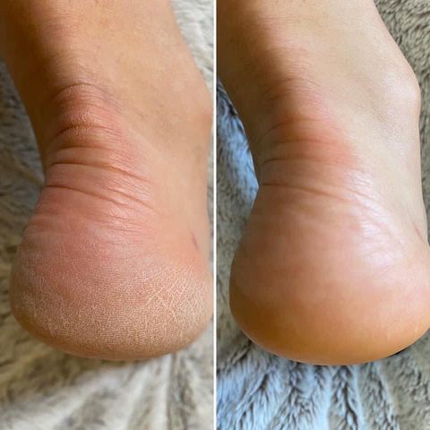 Treat Your Feet -- Sole Solution