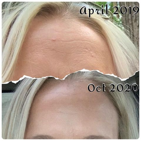 Tru Face Line Corrector