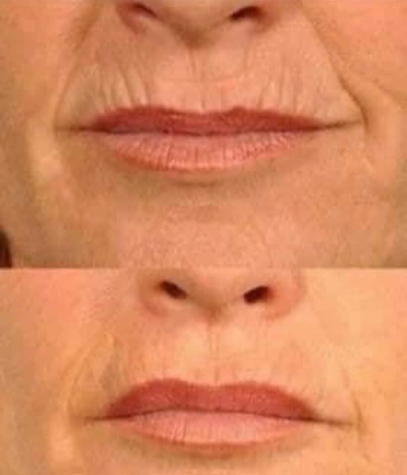 Tru Face Line Corrector