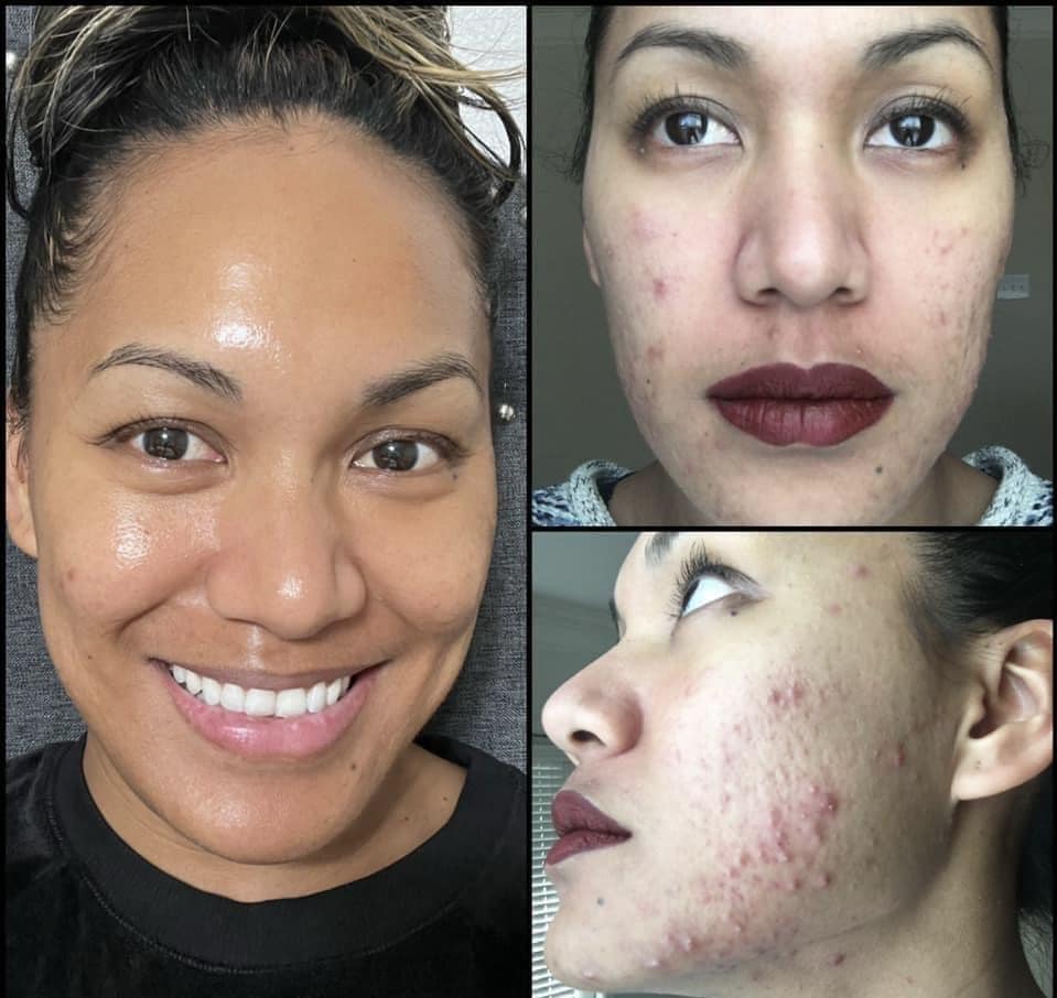 ageLoc Blemish Serum