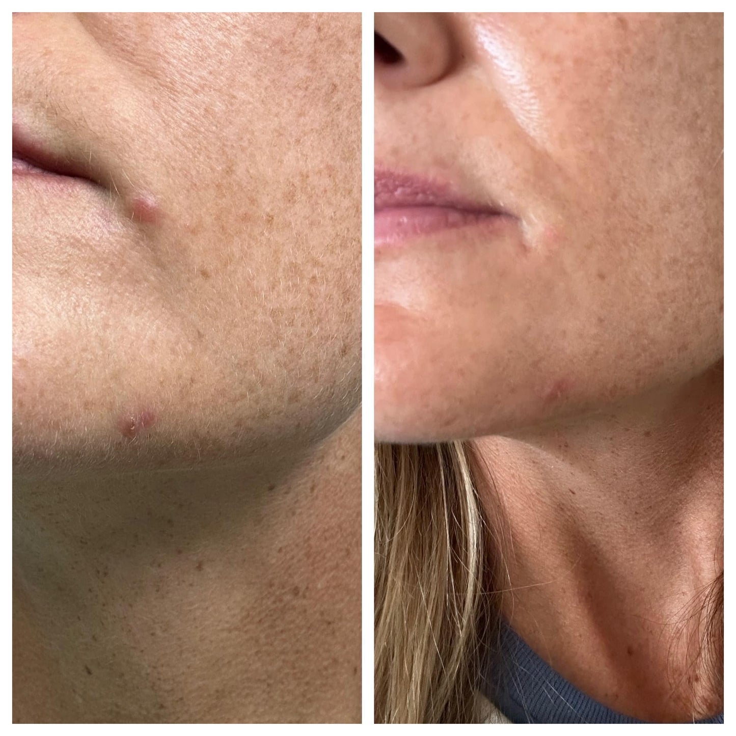 ageLoc Blemish Serum