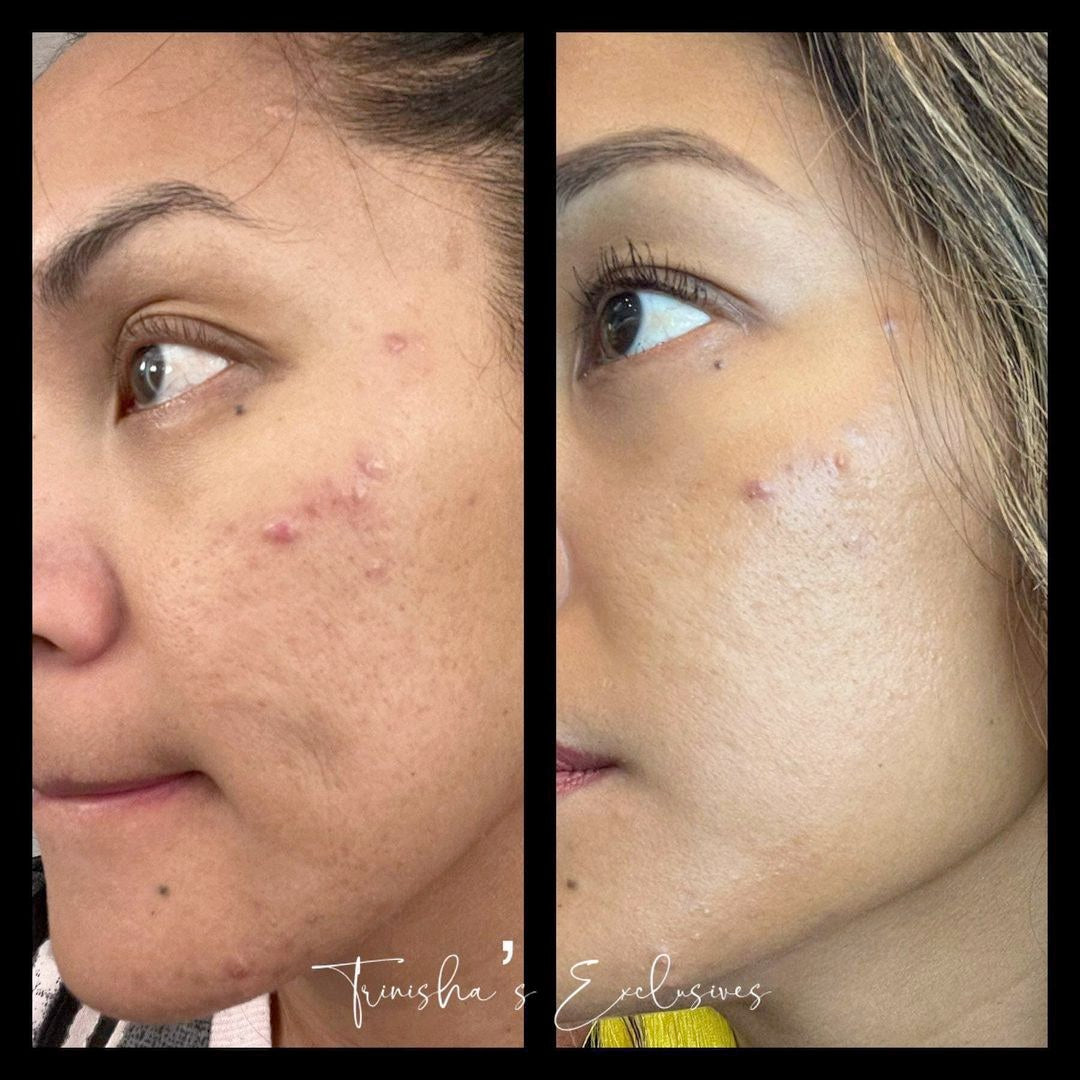 ageLoc Blemish Serum