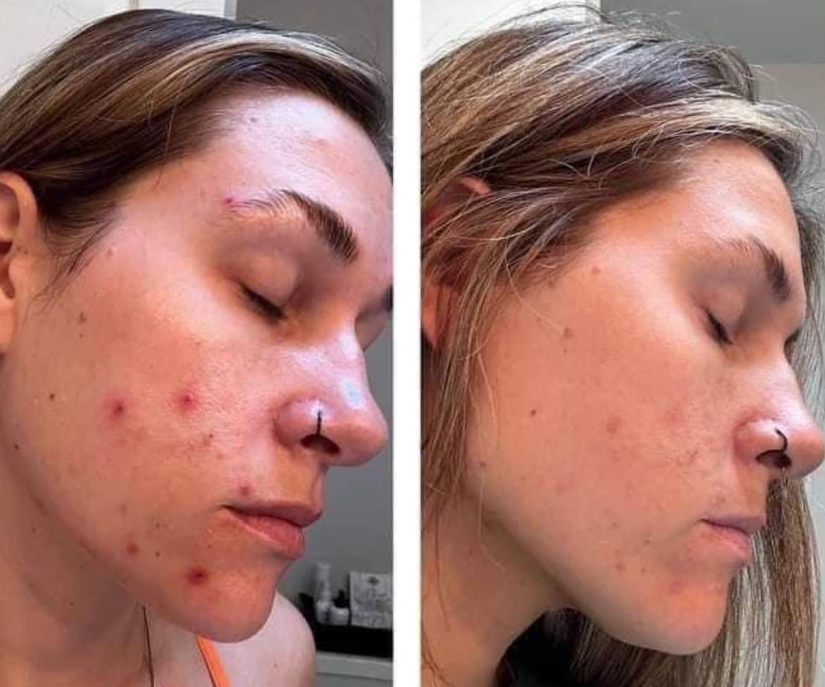 ageLoc Blemish Serum