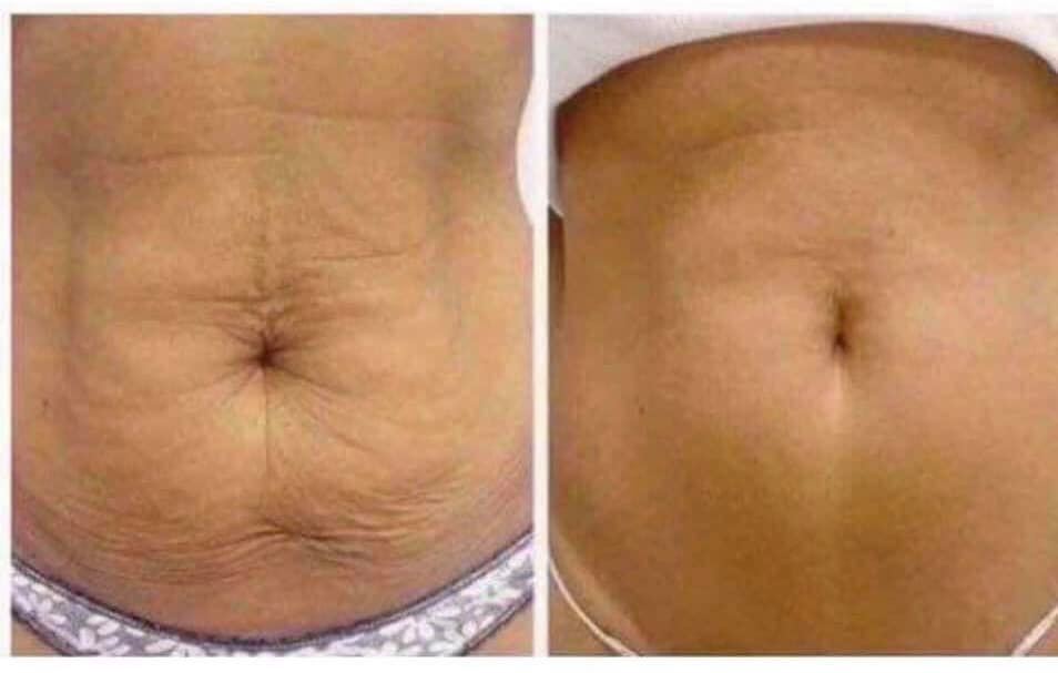 Firm It Up -- Dermatic Effects!