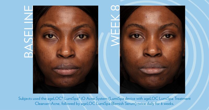 ageLoc Blemish Serum