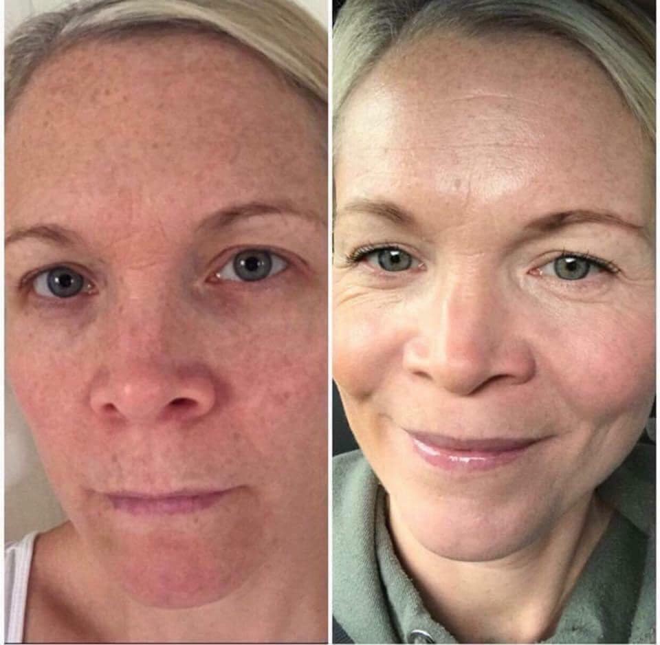 180 AHA Facial Peel and Neutralizer