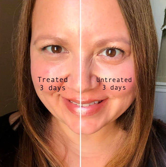 LumiSpa iO Eye Accent Attachment