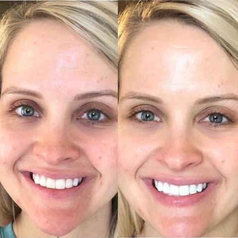 180 AHA Facial Peel and Neutralizer