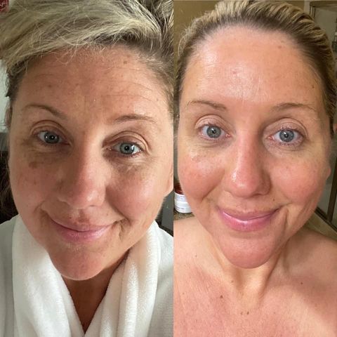 180 AHA Facial Peel and Neutralizer